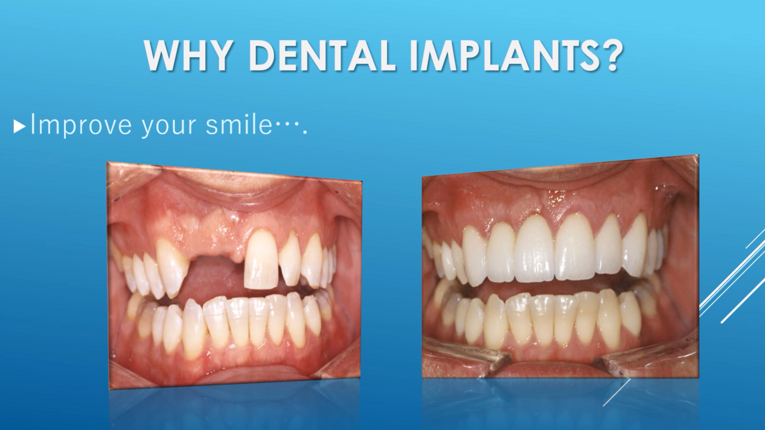 Why Dental Implants